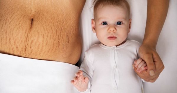 Pregnancy stretch marks removal