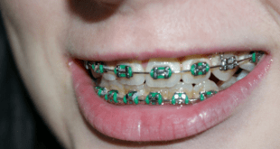 Get braces for your kid