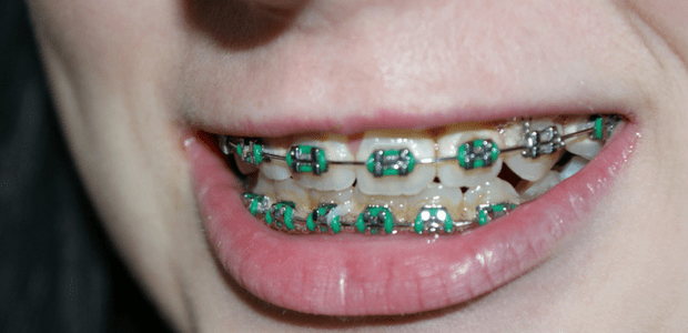 Get braces for your kid