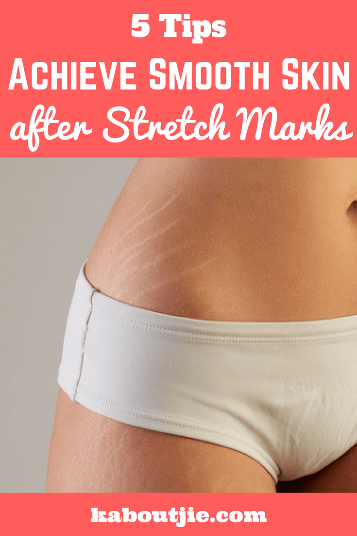 5 Tips Oh Now To Achieve Smooth Skin After Stretch Marks