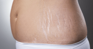 Stretch marks on stomach and back