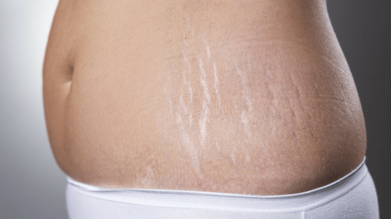 Stretch marks on stomach and back