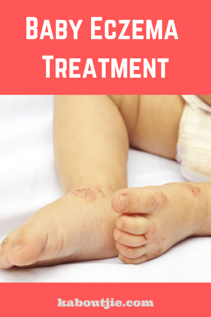 Baby Ezcema Treatment