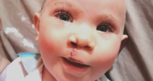 Cleft Lip Repair Procedure